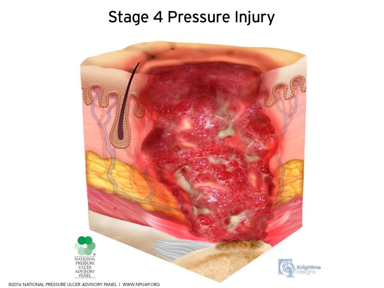 Deep Tissue Pressure Injury